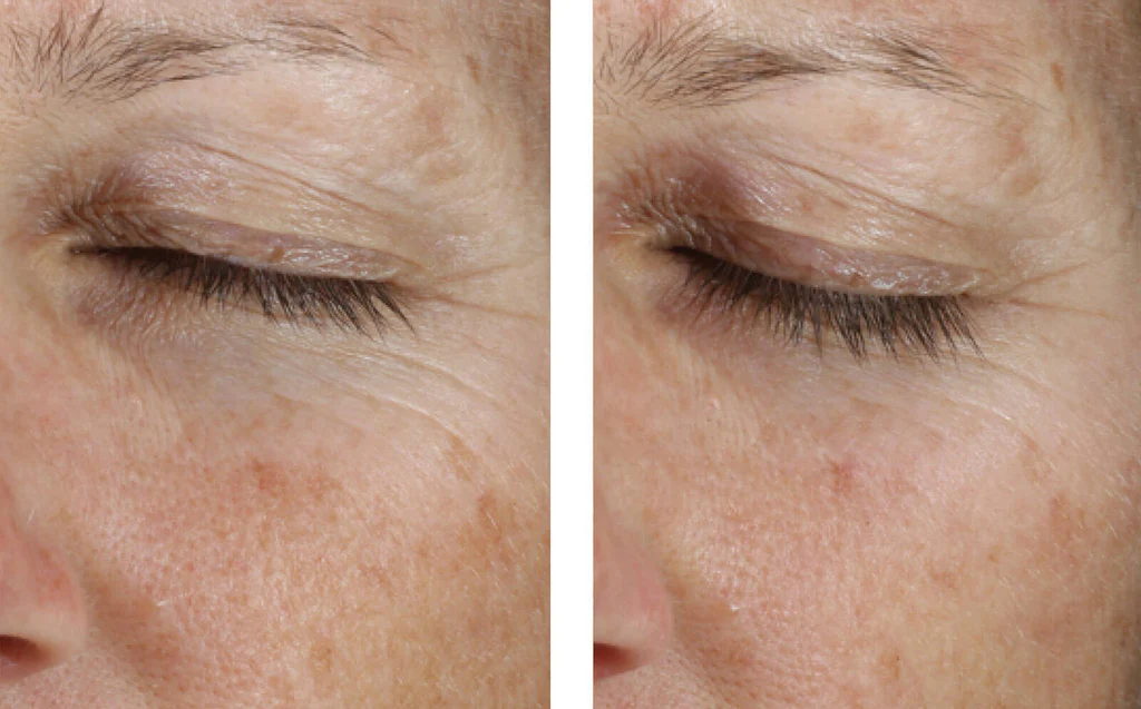 EyeGel_Results3HQP1600x995_v1_1024x1024