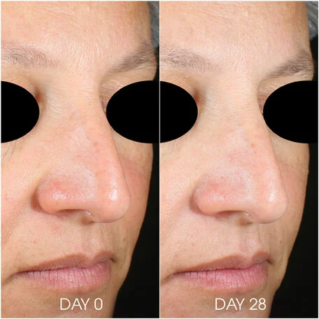 HydraMask_Before_After TEOXANE RHA® ️HYDRA MASK - 50ML - imagine 2